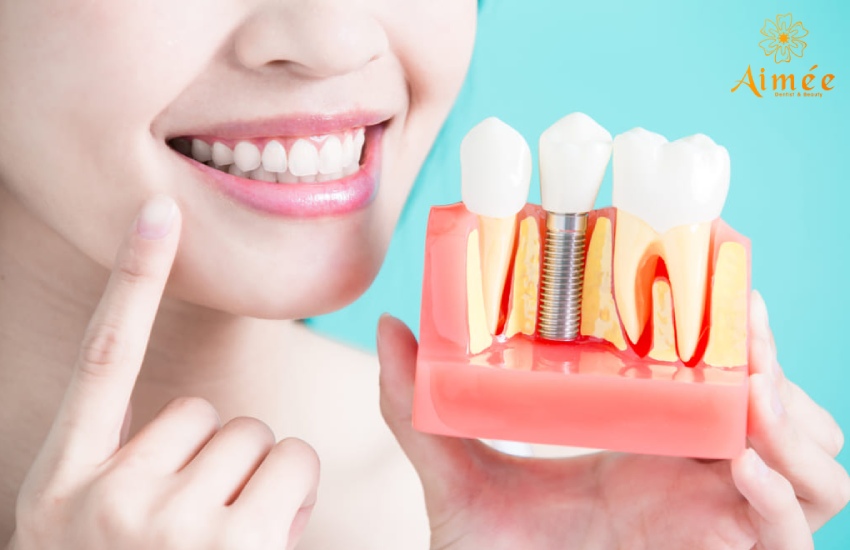 Trồng răng implant ở đâu tốt HCM?