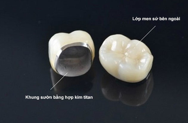 [Kiến thức nha khoa] Răng sứ Titan có mấy loại?