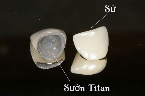 [Kiến thức nha khoa] Răng sứ Titan có mấy loại?